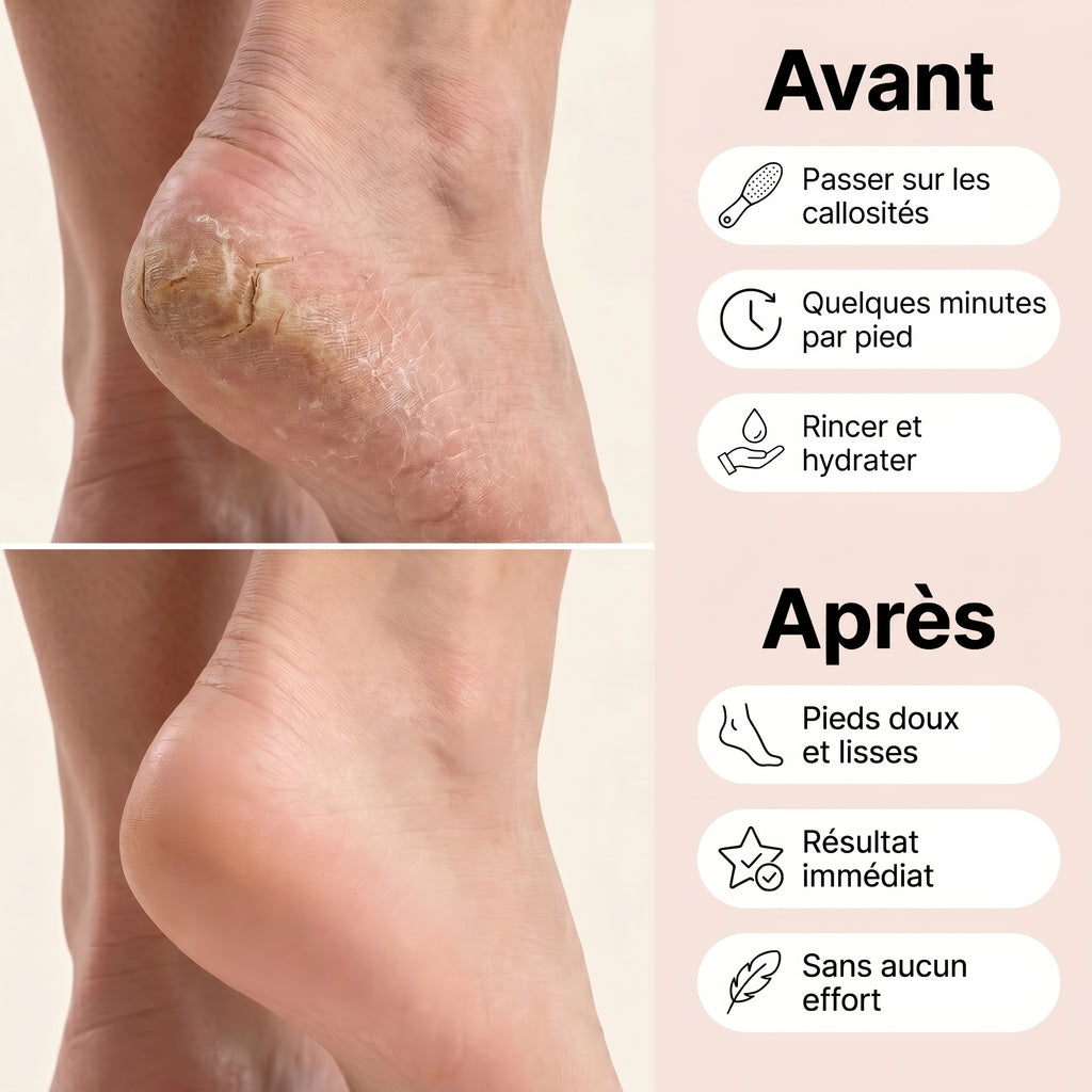 Sofelya — Râpe électrique anti-callosités
